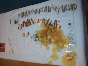 Κουταλάκια, βίδες, νομίσματα και λεπίδες στο στομάχι 52χρονου (ΦΩΤΟ)