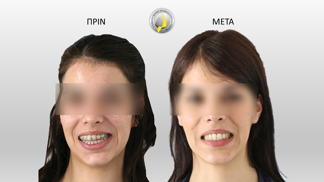 Ασυμμετρίες προσώπου και ό,τι χρειάζεται να ξέρετε