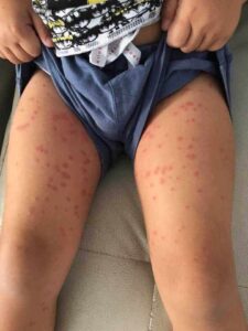 Αναστάτωση σε γνωστή παραλία της Λεμεσού λόγω εξανθημάτων λουόμενων (BINTEO)