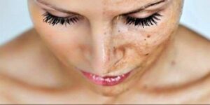 Αυτές είναι οι παθήσεις που προκαλούνται από την πολύχρονη έκθεση στον ήλιο