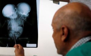 "Έσβησαν" τα σιαμαία βρέφη που νοσηλεύονταν σε νοσοκομείο της Υεμένης