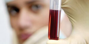 Αυξάνονται τα περιστατικά καρκίνου του εντέρου