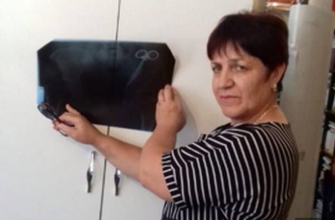 Έζησε για 23 χρόνια με ένα ξεχασμένο ψαλίδι στην κοιλιά…