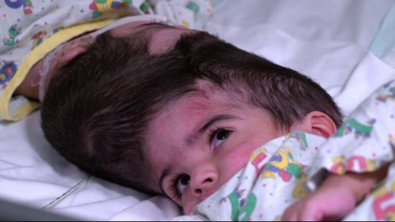 Σιαμαία κοριτσάκια διαχωρίστηκαν μετά από 50 ώρες στο χειρουργείο (ΒΙΝΤΕΟ&ΦΩΤΟ)