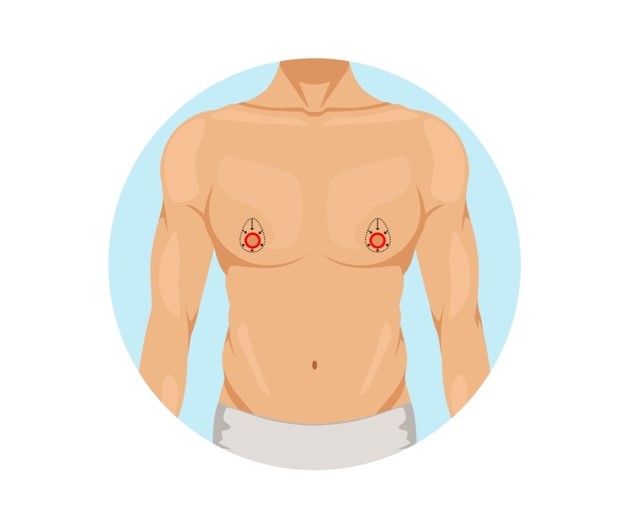 Γυναικομαστία