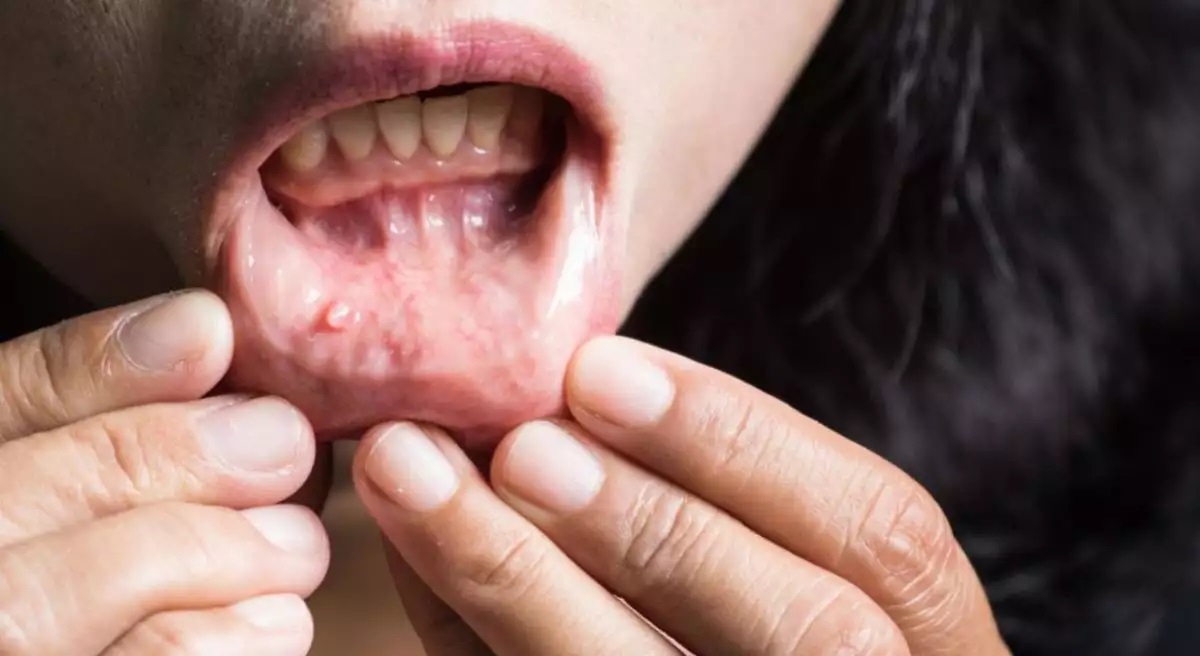 Υπουργείο Υγείας: Εβδομάδα ενημέρωσης και πρόληψης για τον καρκίνο του στόματος