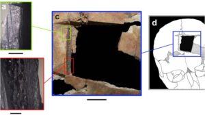 Ενδείξεις για χειρουργείο στον εγκέφαλο πριν 3.500 χρόνια στο Ισραήλ