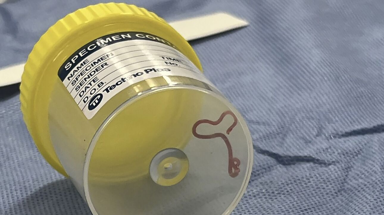 Πρωτοφανές χειρουργικό εύρημα 8cm στον εγκέφαλο γυναίκας