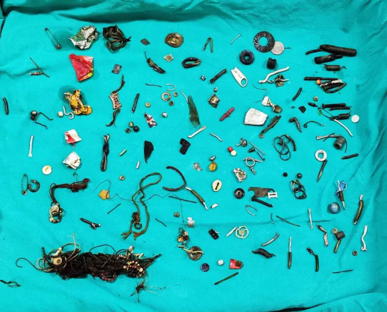 Πήγε με στομαχόπονο στο νοσοκομείο και έβγαλαν από το έντερo του 60 αντικείμενα