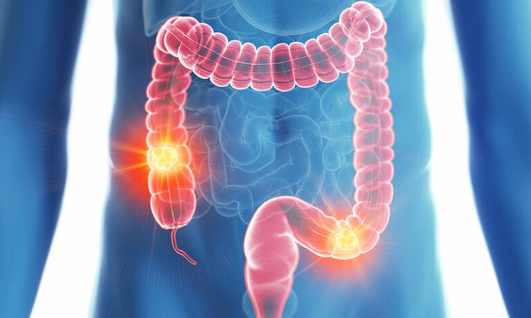 350 νέα περιστατικά καρκίνου του παχέος εντέρου κάθε χρόνο στην Κύπρο