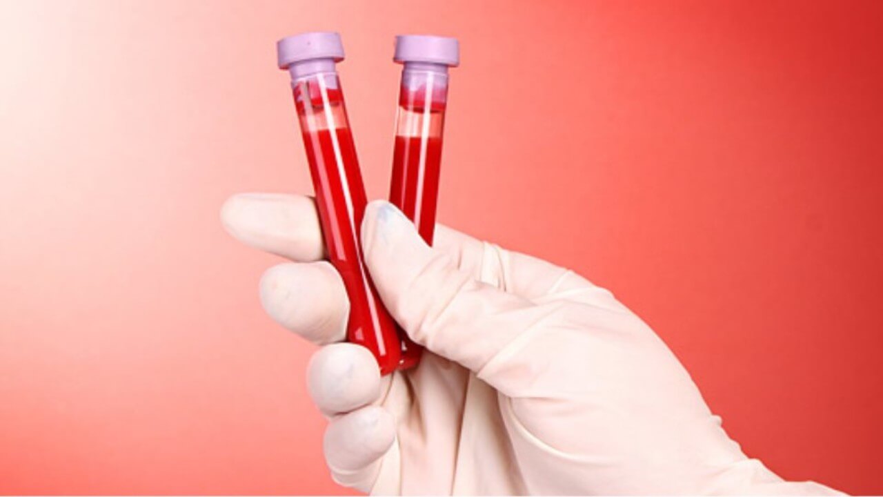 Στην Κύπρο 1.400 ασθενείς με αιμοσφαιρινοπάθειες